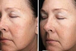 Retinol Benefits: Reducing Wrinkles, Fine Lines, and Dark Spots