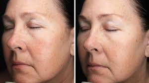 Retinol Benefits: Reducing Wrinkles, Fine Lines, and Dark Spots